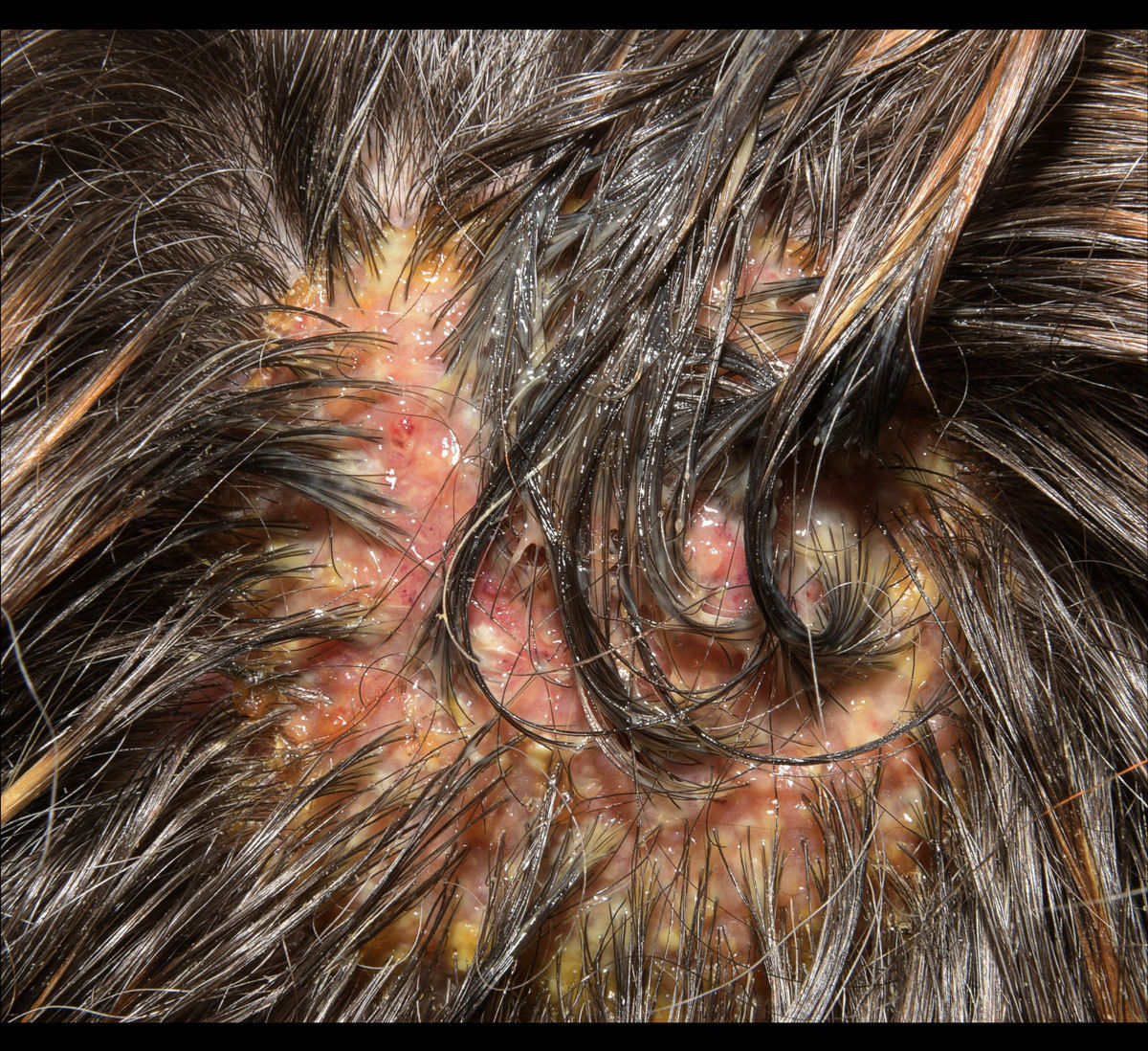 Es beginnt mit Pusteln, doch sehr schnell können sich auf der Kopfhaut bienenwabenartige infektiöse Stellen bilden. © Höpfl