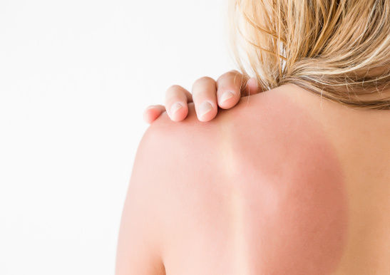 zu_viel_Sonne_V2_157370281.jpg © fotoduets zu_viel_Sonne_V2_157370281.jpg © fotoduets